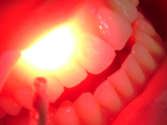 Extração dental a laser