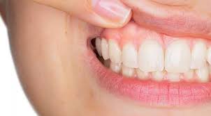 É possível fazer Remoção de Implante Dentário?