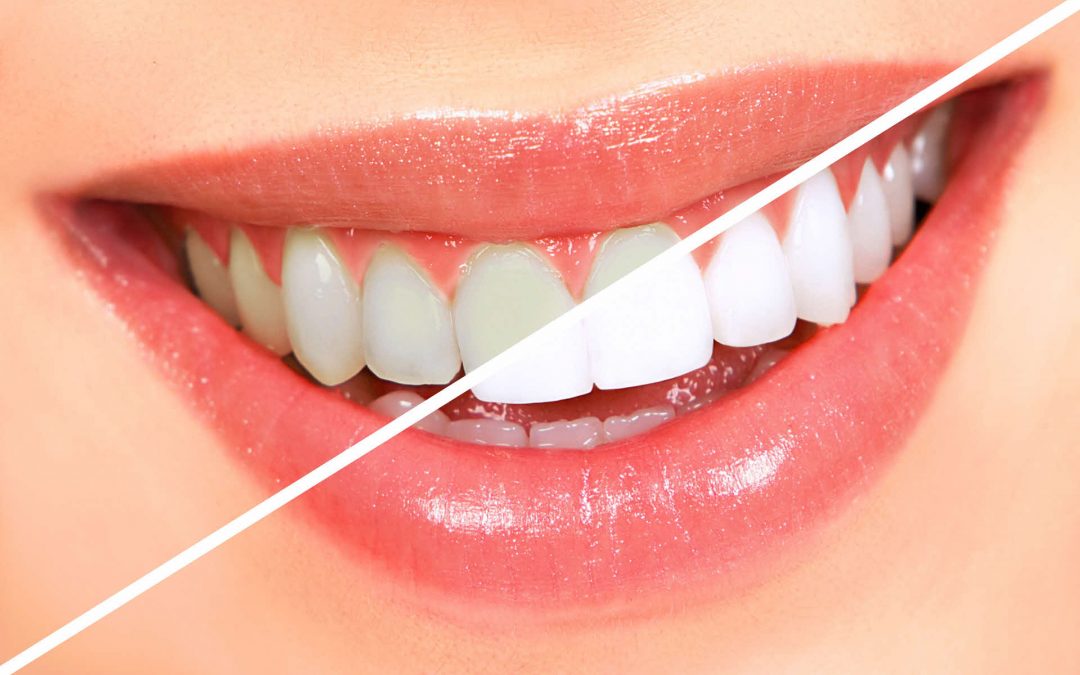 Clareamento Dental: Trate Estética de seus Dentes