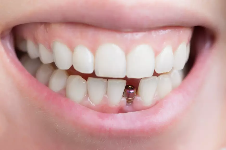 Tem idade certa para fazer um implante nos dentes?