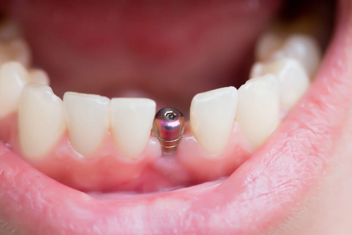 implante dentário fica dolorido