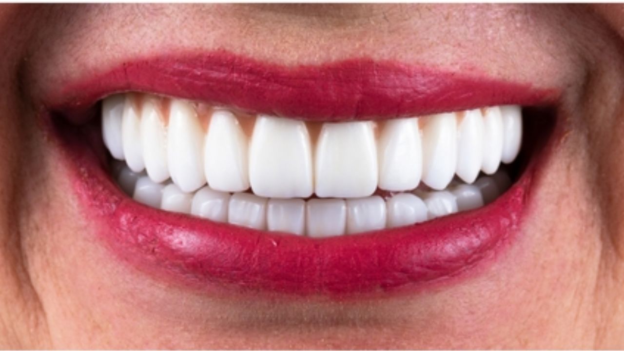 Lente de contato dental em promoção: O barato sai caro