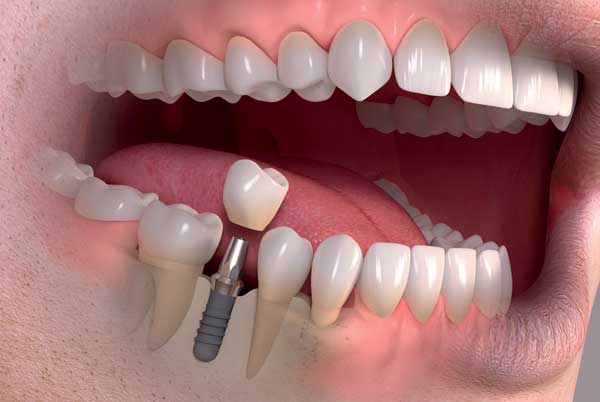 Conheça são os tipos de implantes dentários