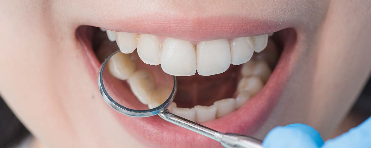 Cárie Dentária