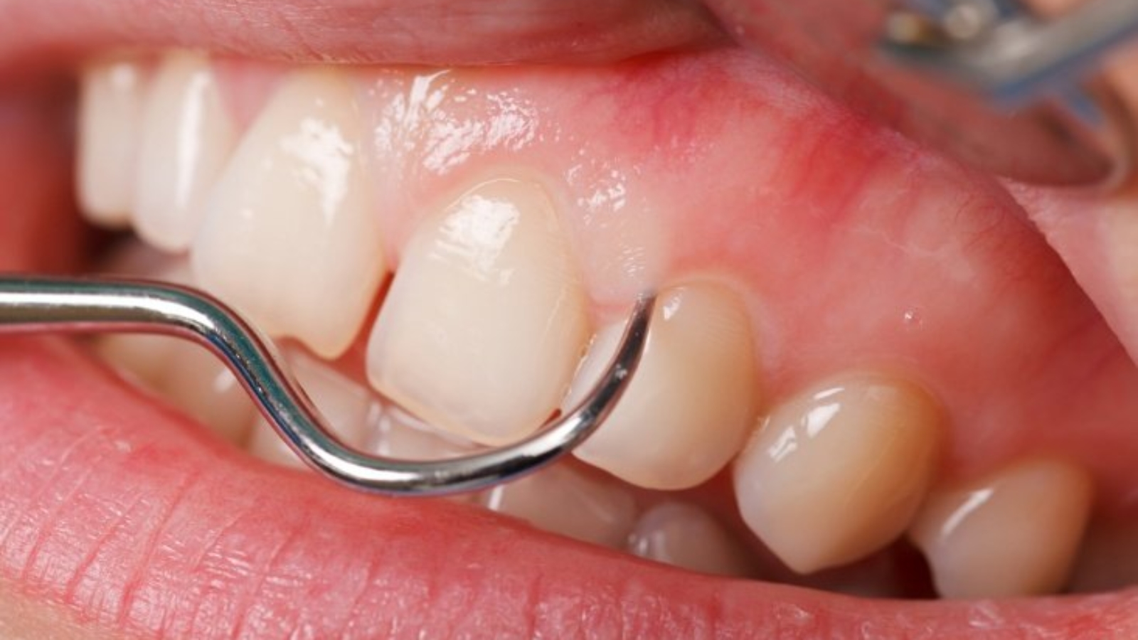 Doenças Periodontais: Saiba Como ter Dentes Saudáveis
