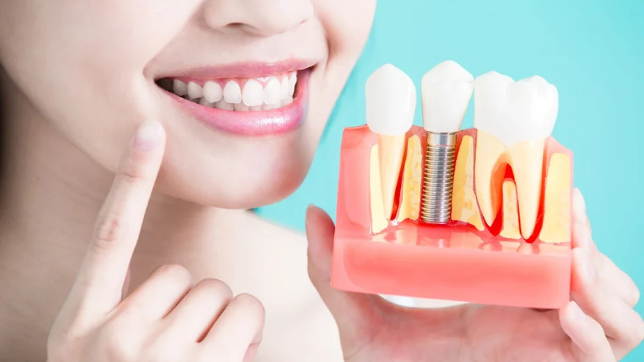 Implante Dentário ou Dentadura